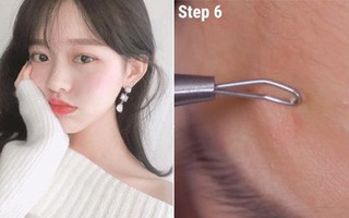 Nếu bạn đang khổ sở vì mụn đầu trắng thì đây chính là bí kíp nặn mụn chuẩn nhất dành cho bạn