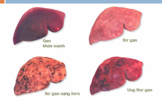 70 - 80% ca mắc ung thư gan xuất phát từ nguyên nhân này, hãy phòng tránh ngay từ hôm nay