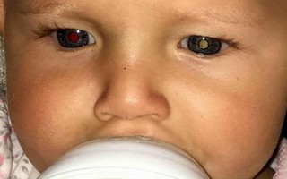 Thấy con có những đốm sáng trong mắt, mẹ không ngờ đó là biểu hiện của bệnh ung thư mắt hiếm gặp