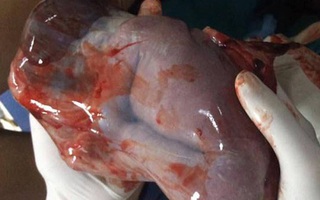 Thật kì diệu: Một bà mẹ ở Nghệ An sinh con vẫn cuộn tròn trong túi ối