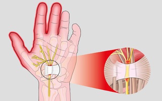 Triệu chứng tê bại ở tay không hẳn do thiếu canxi mà có thể xuất phát từ 10 nguyên nhân không ngờ