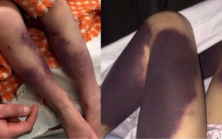 Từ vết bầm nhỏ, chân cô bé 4 tuổi đổi màu đen và suýt phải cưa bỏ vì một căn bệnh phổ biến