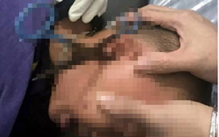 Hà Nội: Bác sĩ cứu sống cháu bé 3 tuổi bị kéo đâm vào tai, xuyên thái dương