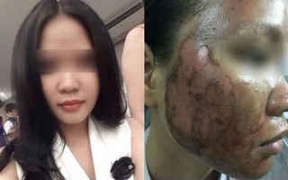 Ký ức kinh hoàng sau lần làm đẹp dại dột đến bỏng rộp cả mặt của cô gái trẻ
