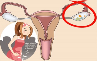 3 yếu tố có thể dẫn đến xoắn buồng trứng, bạn hãy xem để biết mình có nguy cơ bị bệnh không