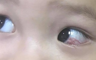 Cha mẹ chở "đi bão" mừng U23 Việt Nam chiến thắng, bé trai 16 tháng tuổi bị cán cờ quẹt chảy máu tròng mắt