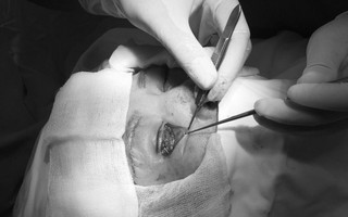 Đua nhau đi làm đẹp đón Tết với giá rẻ, nhiều chị em thủng mũi, biến dạng mí mắt, lõm má