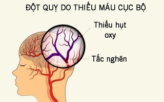 7 triệu chứng đột quỵ ở phụ nữ dù còn trẻ chị em cũng không được bỏ qua
