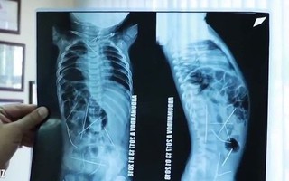 Con sốt cao, tiểu tiện khó khăn, mẹ đưa đến bệnh viện và ngã quỵ khi nhìn thấy hình chụp X-quang