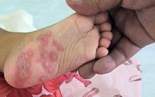 Tay chân miệng có thể biến chứng tử vong: BS bệnh viện Nhi khuyến cáo 4 việc cần làm ngay