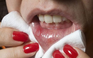 Những cảnh báo về sức khỏe khi tiết nhiều nước bọt
