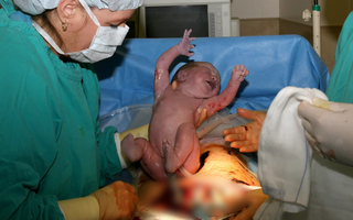 Đang nằm trên bàn mổ bắt con, mẹ 30 tuổi bất ngờ ngưng tim vì tai biến sản khoa vô cùng nguy hiểm