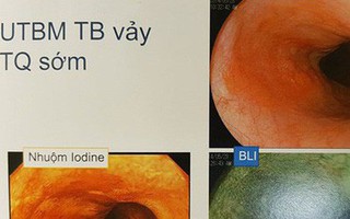 PGS Nhật Bản chỉ rõ đối tượng có nguy cơ cao mắc ung thư thực quản