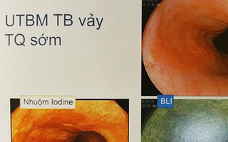 PGS Nhật Bản chỉ rõ đối tượng có nguy cơ cao mắc ung thư thực quản