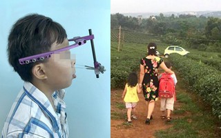 Cậu bé bị lệch hàm tới 20cm, phẫu thuật 10 lần không được, mẹ nghẹn ngào khi bác sĩ dùng cách này để "cứu" con