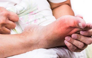 30 tuổi trở đi, nếu có dấu hiệu này cần phải cảnh giác ngay với bệnh gút