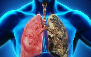 Vì sao số người mắc ung thư phổi ngày càng tăng? Chuyên gia cảnh báo nguyên nhân là thứ chúng ta đang tiếp xúc hàng ngày