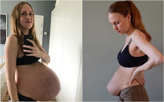 Bà mẹ sinh ba có bụng bầu dài bất thường lại gây sốt với vòng hai như chưa đẻ sau khi sinh 1 tháng