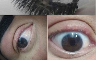 Người phụ nữ bị rụng hết lông mi thật sau nối mi, bác sĩ cảnh báo điều cần làm trước khi quyết định nối mi