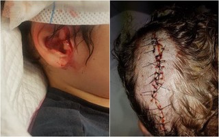 Để con tự chơi trong vườn, chỉ vài giây sau mẹ nghe tiếng hét chói tai và thấy máu chảy ồ ạt trên đầu con