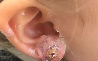 Nguy hiểm từ việc bấm lỗ tai làm đẹp cho bé ít cha mẹ nào nghĩ tới