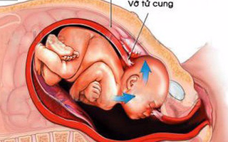 Sản phụ Hà Nội vỡ tử cung suýt tử vong: Chuyên gia khuyến cáo tai biến sản khoa nguy hiểm