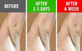 Đừng cố tình bỏ qua 6 biểu hiện ở nách vì nó có thể chỉ ra bệnh tiềm ẩn, không ngoại trừ ung thư