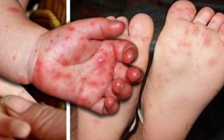 Bác sĩ nhi mách cách phòng ngừa và điều trị khỏi bệnh tay chân miệng hiệu quả nhất