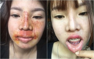 Sự thật về tin đồn hot girl thẩm mỹ Phượng "Thị Nở" bị biến chứng sau thẩm mỹ khiến mặt mũi biến dạng?