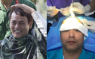 Lộ đầu hói trong "Sao Nhập Ngũ", ông bố đơn thân Ưng Đại Vệ cấy 2 ngàn sợi tóc để thoát cảnh ít tóc