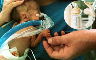 Nhiễm độc sữa mẹ được hút ra từ máy hút sữa, bé sơ sinh mắc bệnh viêm màng não hiếm gặp
