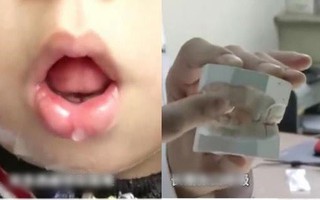Bé trai 5 tuổi không thể ngậm được miệng, bị chẩn đoán mắc dị tật xương hàm vì thói quen của trẻ mà hầu hết phụ huynh đều bỏ qua