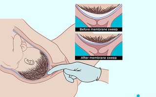 Có một phương pháp kích thích chuyển dạ tự nhiên mà không cần dùng thuốc ít người biết đến