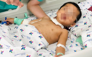 Bé trai 3 tuổi ngưng tim, ngưng thở nguy kịch nhưng cha mẹ không biết con đã nuốt hạt mãng cầu