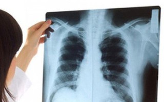 Dấu hiệu sớm căn bệnh 'sát thủ' làm 21.000 người Việt Nam chết mỗi năm