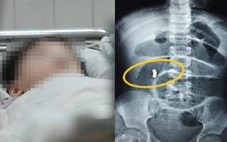 Hiểm họa khôn lường: Nuốt quà sinh nhật mẹ mua, bé gái 6 tuổi suýt chết vì thủng 4 lỗ ở ruột
