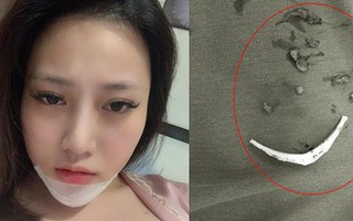 Cô gái trẻ phải tháo độn cằm vì biến chứng do tiêm chất làm đầy từ 4 năm trước: "Mình vẫn đang băng nẹp, không biết tháo ra sẽ thế nào..."