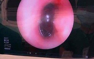 Chuyên gia cảnh báo: Trẻ nhỏ hóc hạt, ho sặc nghẹt đường thở dọa tử vong