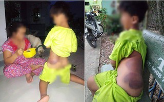 Mẹ học sinh lớp 1 khuyết tật bị giáo viên đánh bầm tím người: "Đừng đuổi việc cô, do cô thương nên mới đánh bé"