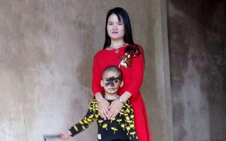Cái Tết trọn vẹn đầu tiên của cậu bé 6 tuổi có khuôn mặt tựa "người rừng" tại Yên Bái