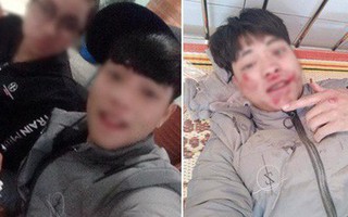 Bị té xe đến chảy máu khắp mặt, thanh niên vẫn tươi cười selfie rồi đăng facebook: “Quan trọng là cái thần thái!”