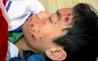 Nổ điện thoại khi đang sạc, nam sinh lớp 8 bị thương nặng