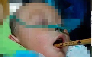 Cầm đũa đùa chơi không may vấp ngã, bé trai 1 tuổi bị chấn thương nội sọ, sức khỏe nguy kịch