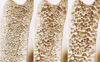 Đây là những căn bệnh bạn có nguy cơ mắc phải nếu để cơ thể thiếu hụt vitamin K