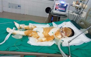 Thái Bình: Chập điện cháy nhà giữa đêm, vợ chồng bỏng nặng, bé gái 4 tuổi nguy kịch