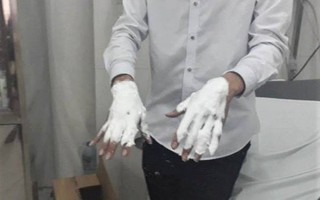 Hà Nội: Mua bóng bay galaxy về bán, 3 sinh viên nữ bị bỏng nặng ở vùng mặt, lông mày cháy xém