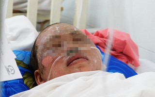 Chồng hút thuốc khi đi vệ sinh, 4 người trong một gia đình bỏng nặng vì nổ hầm cầu?