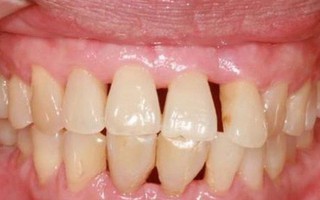 Vệ sinh răng miệng kém có thể gây ra ung thư phổi, ung thư đại tràng