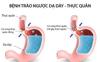 Trào ngược dạ dày thực quản: Những điều cần biết