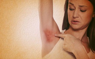 Những biện pháp đơn giản tại nhà giúp trị bệnh viêm tuyến mồ hôi mưng mủ